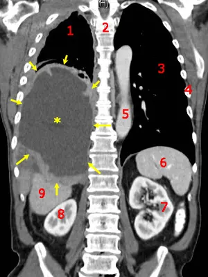 Mesothelioma CT Scan Yellow Arrows Identifying the Cancer