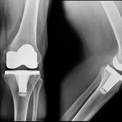 xray after total knee replacement with exactech devices